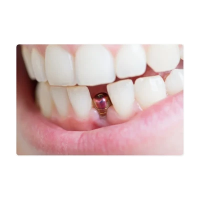 Quali potenziali problemi possono sorgere con gli impianti dentali? Quali pre...
